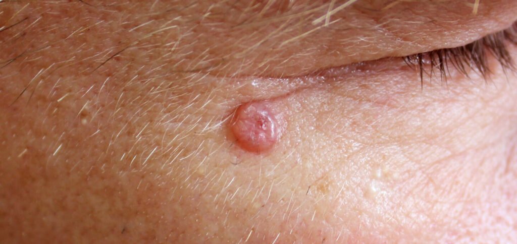 Basal cell carcinoma