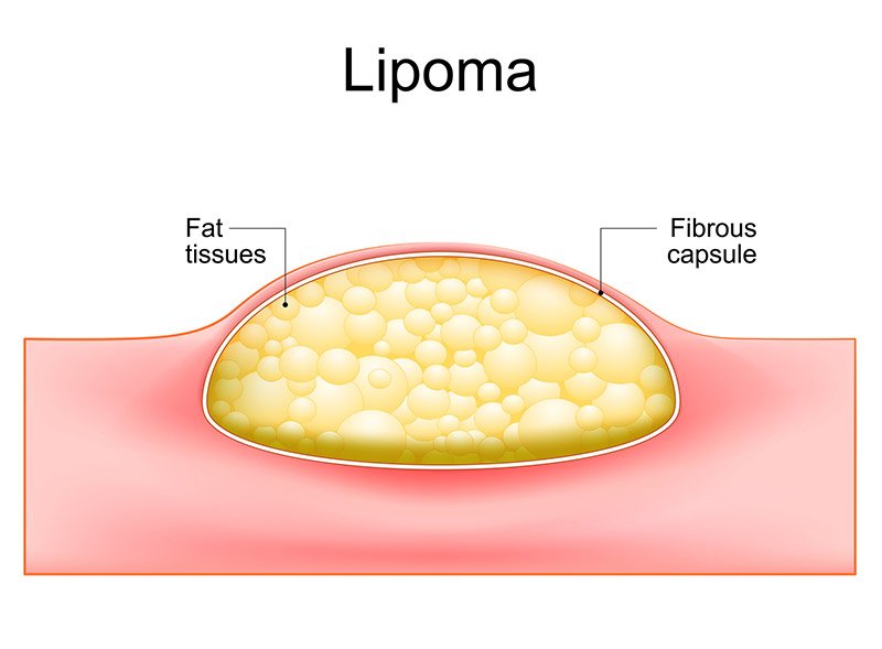 Lipoma diagram