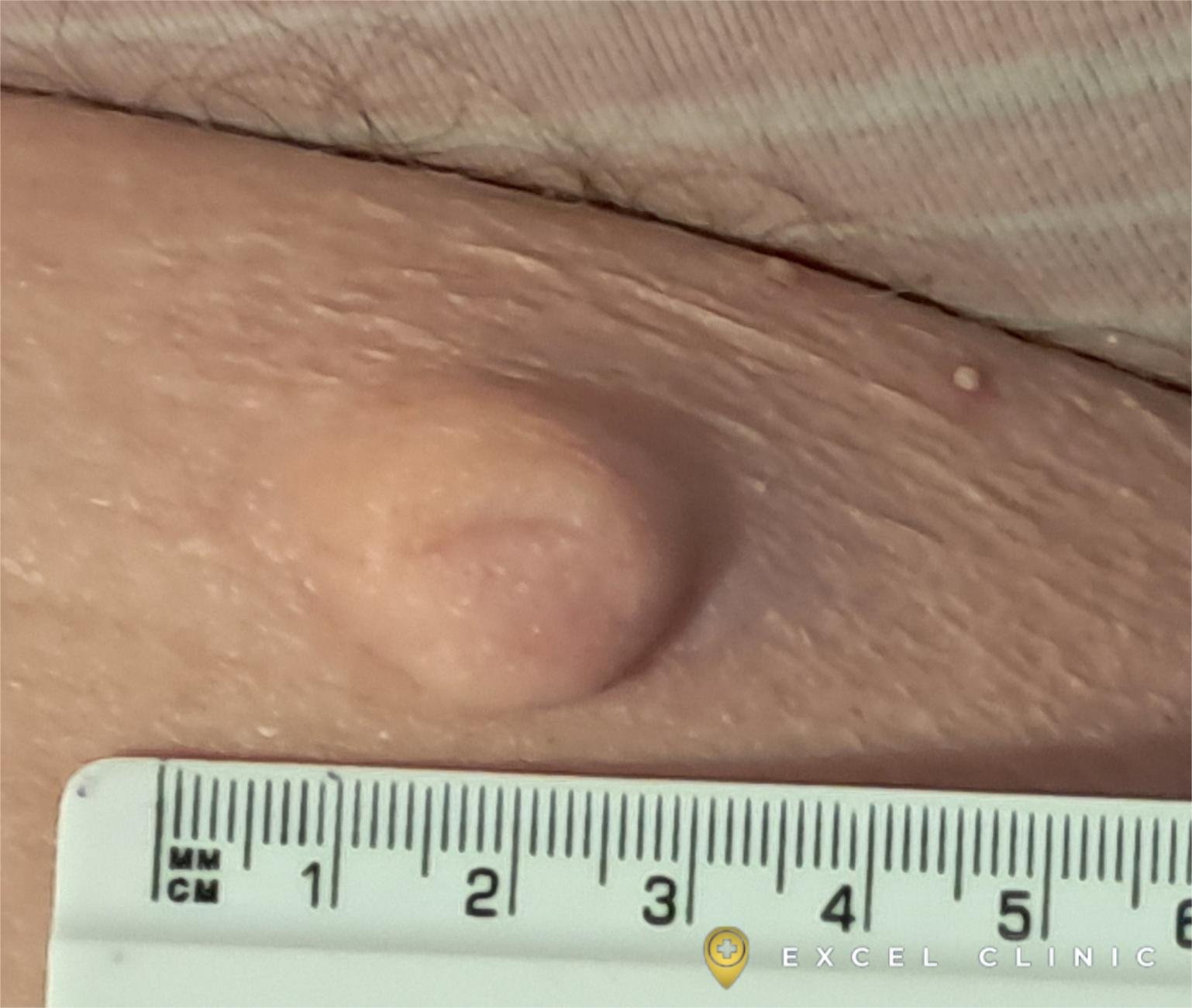 Skin Cyst on thigh