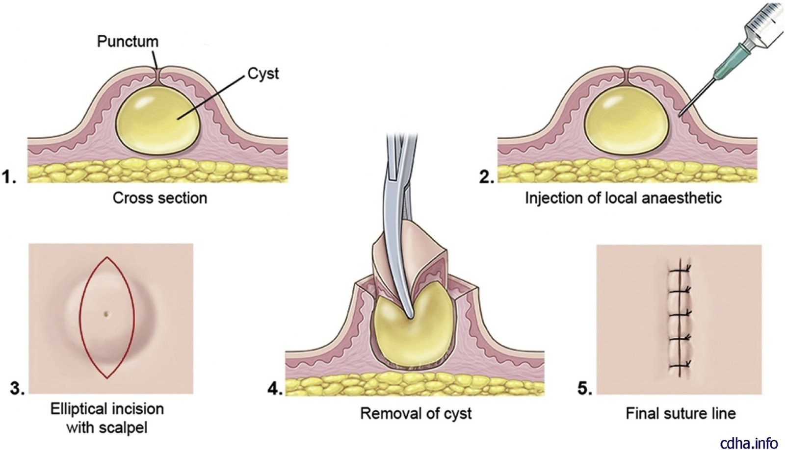 diagram of sebaceous cyst removal stages