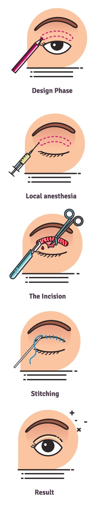 stages of blepharoplasty eyelid surgery diagram