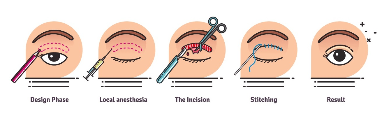 blepharoplasty diagram