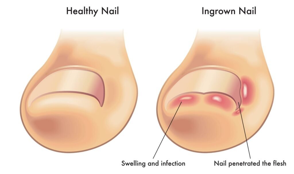 diagram of ingrown toenail
