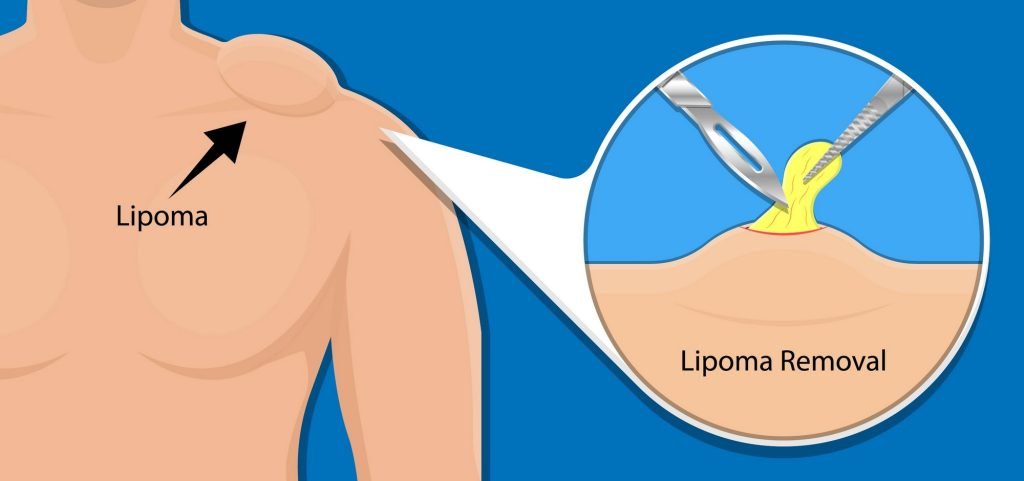 diagram showing lipoma removal surgery at excel clinic