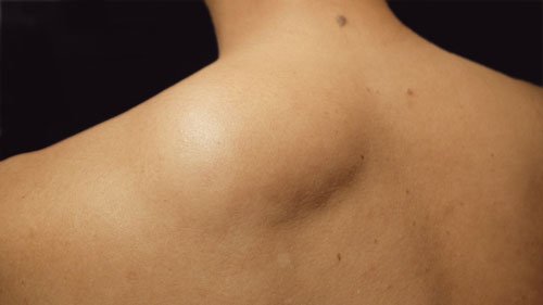 large lipoma on upper back