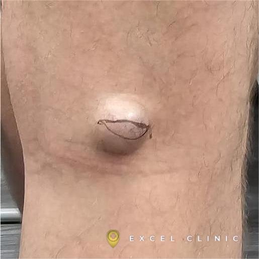Skin Cyst on thigh