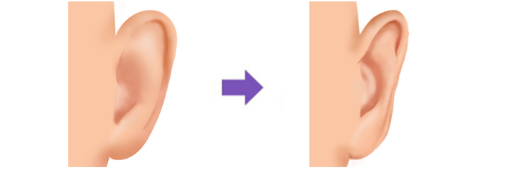pinnoplasty, otoplasty diagram before and after
