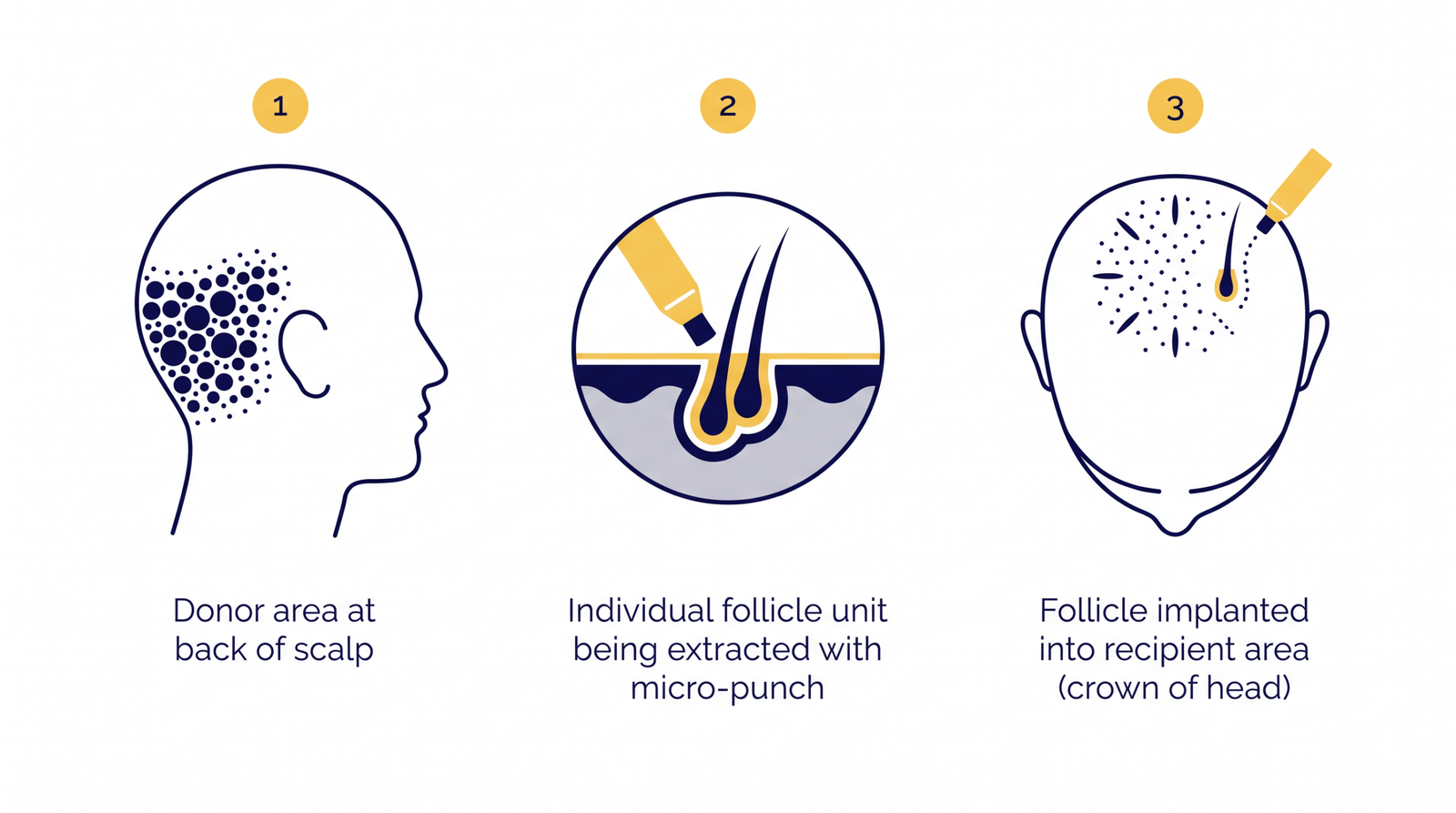 Follicular Unit Extraction (FUE) — the gold standard of modern hair restoration