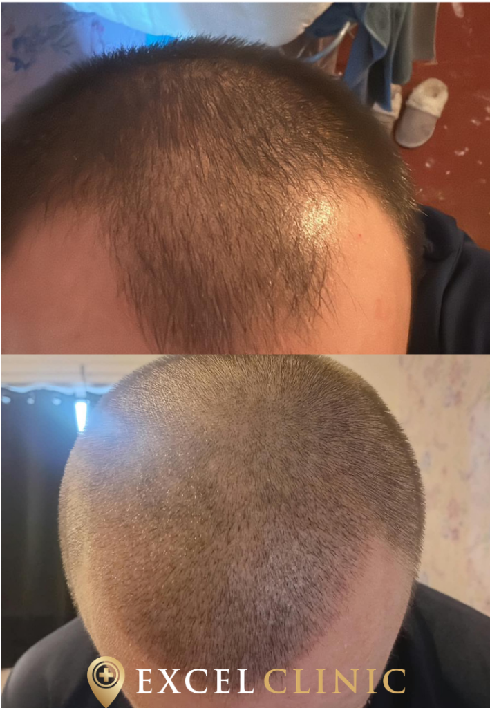 early fue hair transplant results after 10 days in cardiff