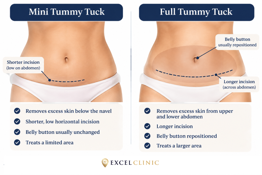 diagram comparing mini tummy tuck to full tummy tuck lso known as abdominoplasty